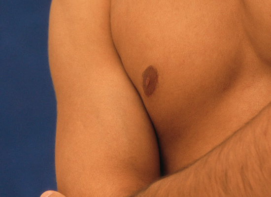 Cirugía Plástica de Reducción de mama Masculina Cirugía Plástica de Reducción de mama Masculina